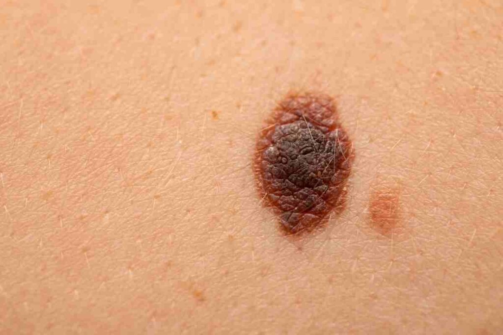 melanoma consigli 