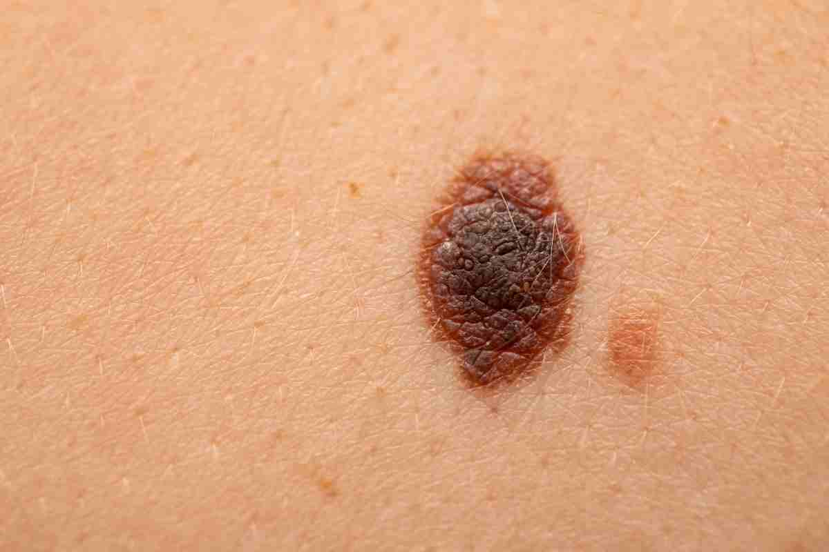 melanoma consigli