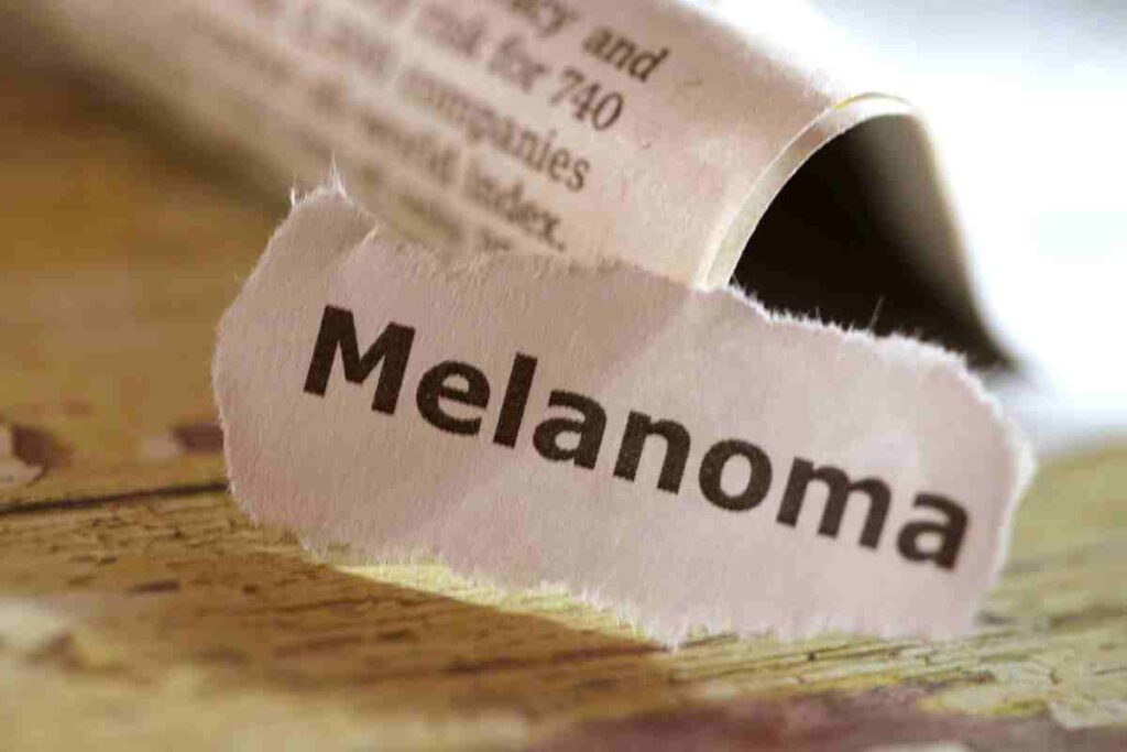 melanoma